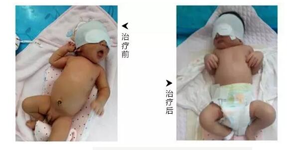 喜讯!博爱新式疗法,治疗新生儿黄疸(图5) 喜讯!博爱新式疗法,治疗新生儿黄疸(图5)